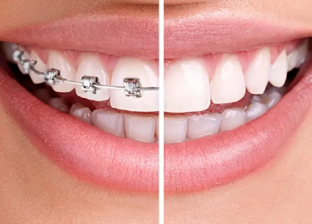 Ortodonzia: Trattamenti per un Sorriso Perfetto