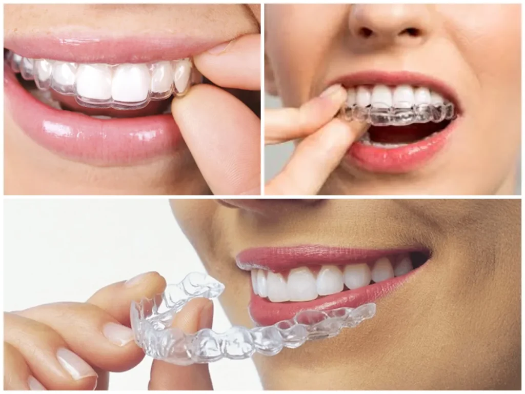 Allinea i Denti con Invisalign