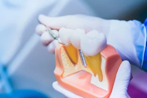 Procedura di Implantologia Dentale